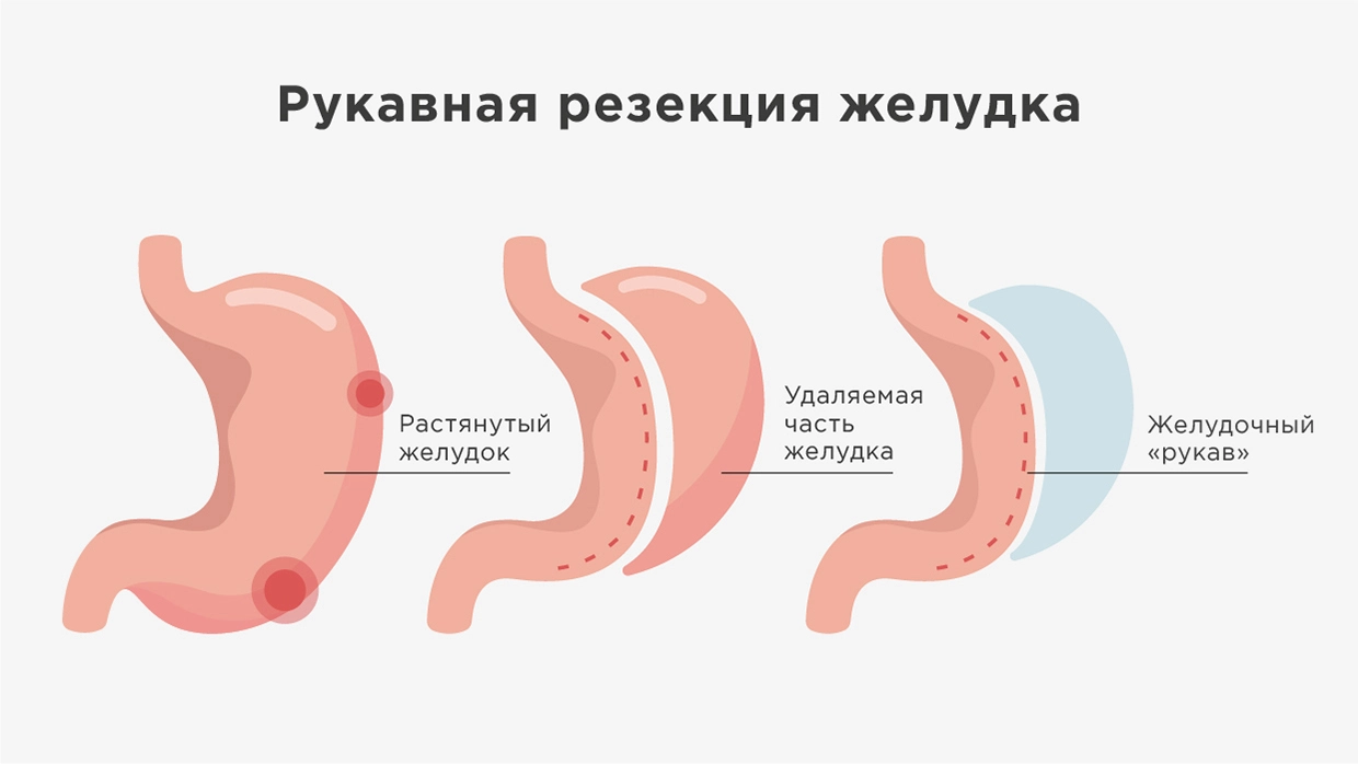 Резекция желудка - показания, виды операций и реабилитация